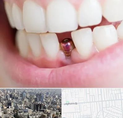 ایمپلنت اقساطی در جیحون