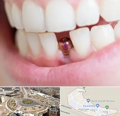 ایمپلنت اقساطی در پرند