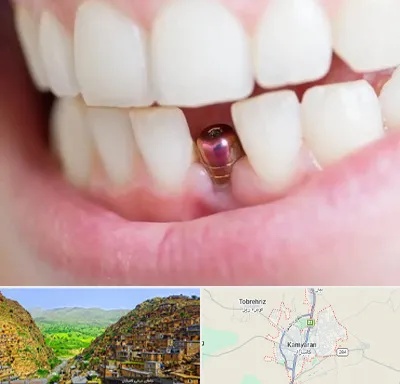 ایمپلنت اقساطی در کامیاران