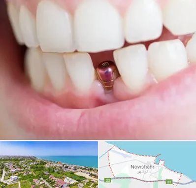 ایمپلنت اقساطی در نوشهر