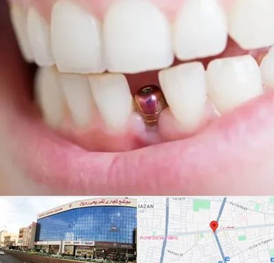 ایمپلنت اقساطی در نصف راه تبریز