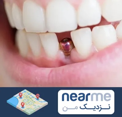 ایمپلنت اقساطی در نزدیک من