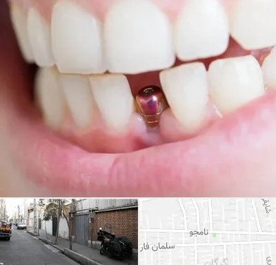 ایمپلنت اقساطی در خیابان نامجو