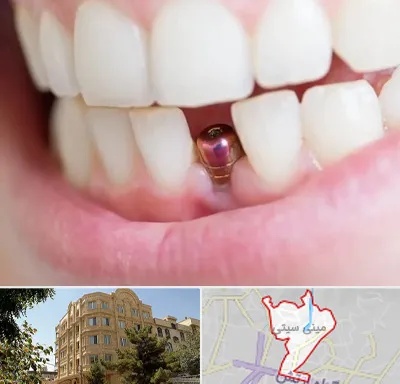 ایمپلنت اقساطی در مینی سیتی