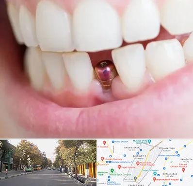 ایمپلنت اقساطی در شریعتی 