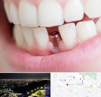 ایمپلنت اقساطی در هفت تیر مشهد 