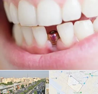 ایمپلنت اقساطی در کیانمهر کرج