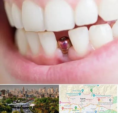 ایمپلنت اقساطی در منطقه 1 تهران 