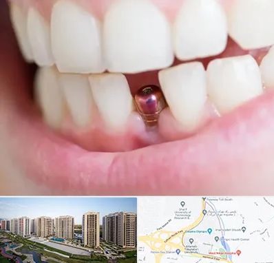 ایمپلنت اقساطی در المپیک 