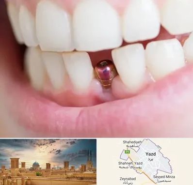 ایمپلنت اقساطی در یزد