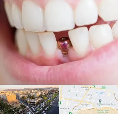 ایمپلنت اقساطی در تهرانپارس 