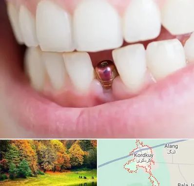 ایمپلنت اقساطی در کردکوی