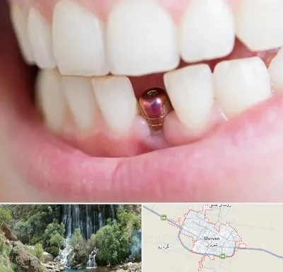 ایمپلنت اقساطی در شیروان