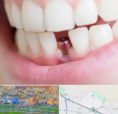 ایمپلنت اقساطی در رشدیه تبریز