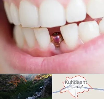 ایمپلنت اقساطی در کوهدشت