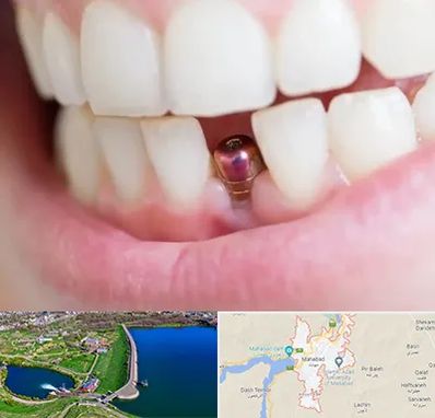 ایمپلنت اقساطی در مهاباد