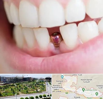 ایمپلنت اقساطی در پردیس