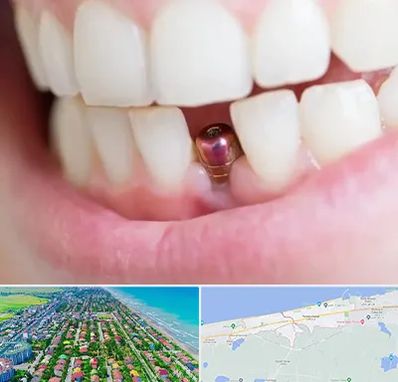 ایمپلنت اقساطی در فریدونکنار