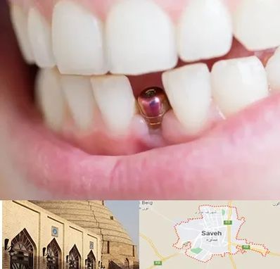 ایمپلنت اقساطی در ساوه