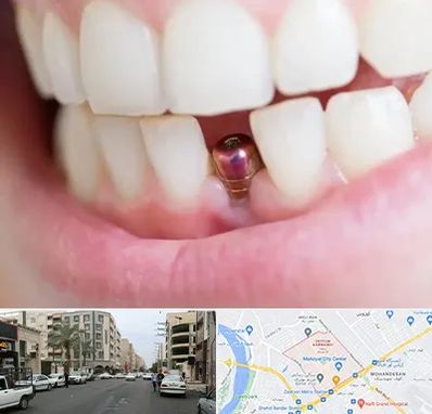 ایمپلنت اقساطی در زیتون کارمندی اهواز