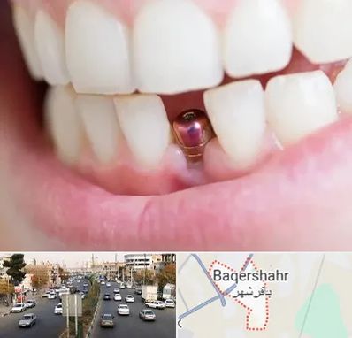 ایمپلنت اقساطی در باقرشهر