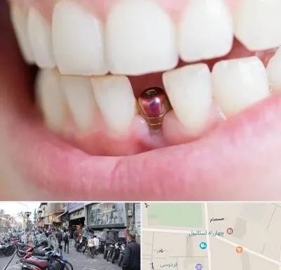 ایمپلنت اقساطی در چهارراه استانبول
