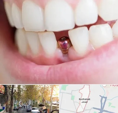 ایمپلنت اقساطی در کاشانک
