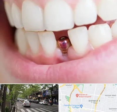 ایمپلنت اقساطی در ظفر 