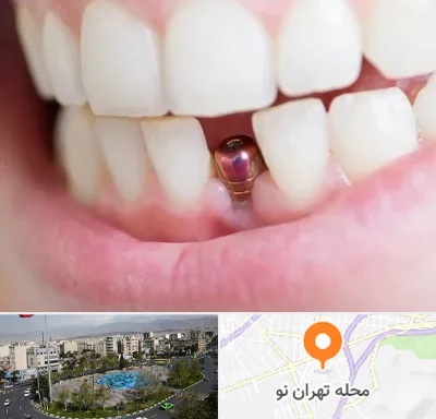 ایمپلنت اقساطی در تهران نو