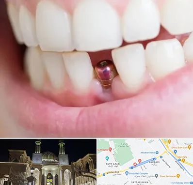 ایمپلنت اقساطی در زرگری شیراز