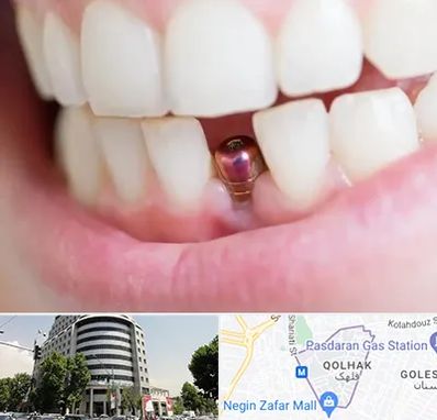 ایمپلنت اقساطی در قلهک 