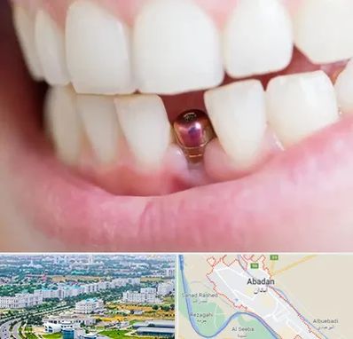 ایمپلنت اقساطی در آبادان