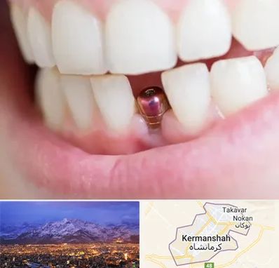 ایمپلنت اقساطی در کرمانشاه