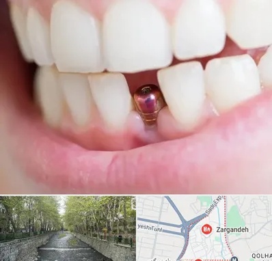 ایمپلنت اقساطی در زرگنده