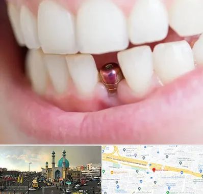 ایمپلنت اقساطی در رسالت 