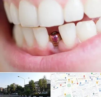 ایمپلنت اقساطی در میدان کاج 