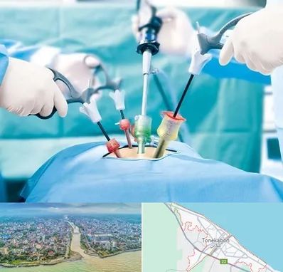 دکتر لاپاراسکوپی در تنکابن