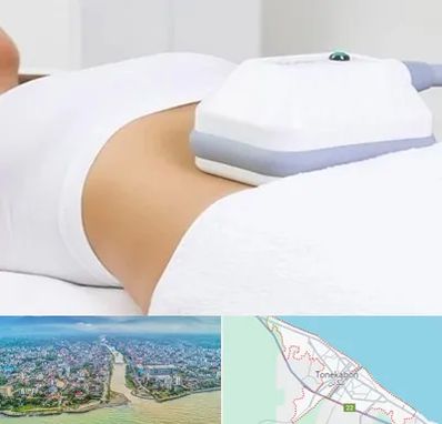 لاغری موضعی در تنکابن