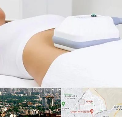 لاغری موضعی در عظیمیه کرج 