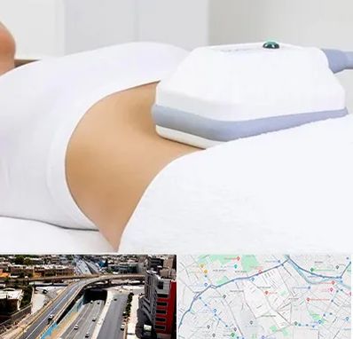 لاغری موضعی در ستارخان شیراز 