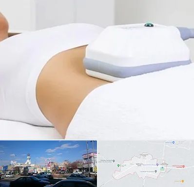 لاغری موضعی در ماهدشت کرج 