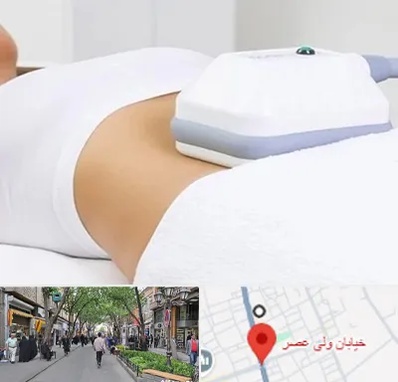 لاغری موضعی در ولیعصر شهریار