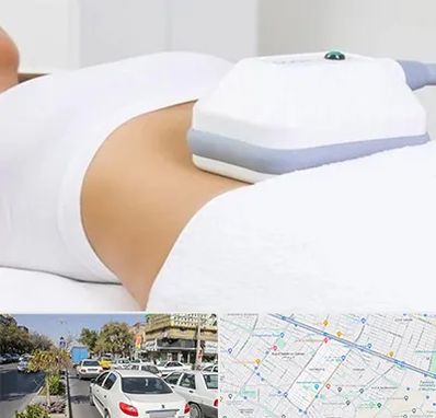 لاغری موضعی در مفتح مشهد 