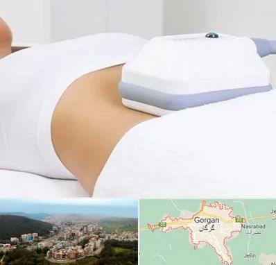 لاغری موضعی در گرگان