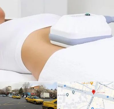 لاغری موضعی در شهناز تبریز