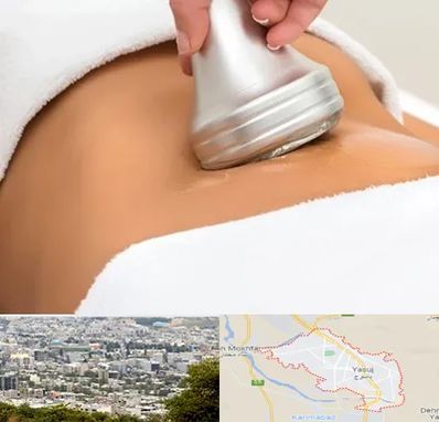 دستگاه لاغری در یاسوج