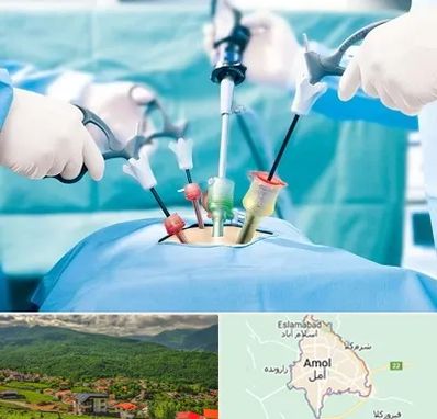 جراح فیبروم در آمل