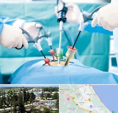 جراح فیبروم در رودسر