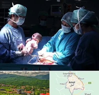 جراح سزارین در آمل
