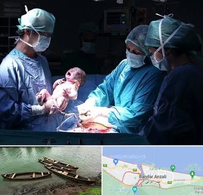 جراح سزارین در بندر انزلی